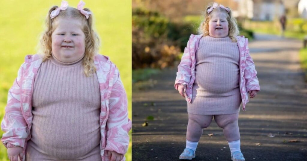 Το πιο σπάνιο σύνδρομο του κόσμου: Η 5χρονη που ζυγίζει 45 κιλά και η αρρώστια που την κάνει διαρκώς να πεινάει