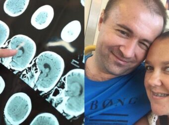 Έπαθε εγκεφαλική λοίμωξη, έχασε την ακοή της: Η “αθώα” καθημερινή συνήθεια που παραλίγο να σκοτώσει 38χρονη μητέρα