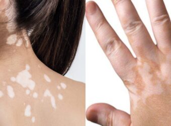 Λευκές κηλίδες στο δέρμα: Κι όμως δεν είναι μόνο ο ήλιος – Οι συχνότερες αιτίες και ο τρόπος αντιμετώπισης