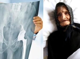 «Έμειναν άφωνοι» οι γιατροί με 99χρονη γιαγιά μετά από εγχείρηση για κάταγμα ισχύου στο νοσοκομείο Μυτιλήνης