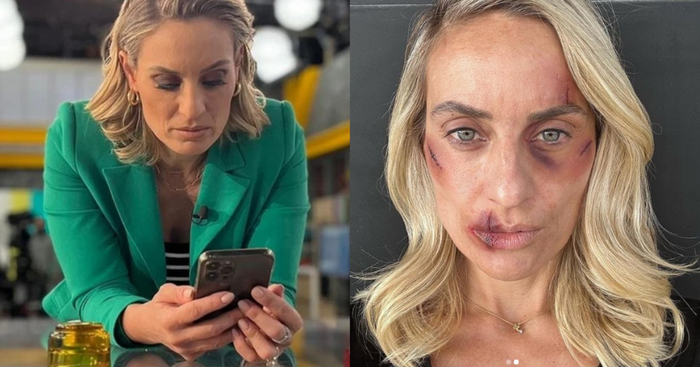 Γεμάτη μώλωπες & πληγές στο πρόσωπο: Οι φωτο της Ελεονώρας Μελέτη μετά το “ξυλοδαρμό” κάνουν τον γύρο του ίντερνετ