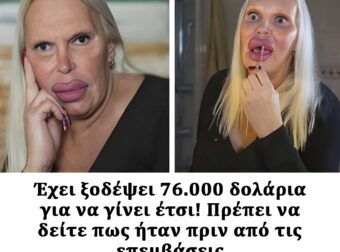 Έκανε πολλές πλαστικές επεμβάσεις. Πρέπει να δείτε πως ήταν πριν από αυτές