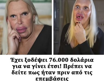 Έκανε πολλές πλαστικές επεμβάσεις. Πρέπει να δείτε πως ήταν πριν από αυτές