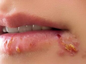 Αν δείτε αυτό να εμφανίζεται στα χείλη σας, είναι σημάδι ότι έχετε έρπητα