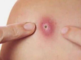 Καλόγερος: Πώς να τον καταπολεμήσετε όταν εμφανίζεται στο σώμα σας