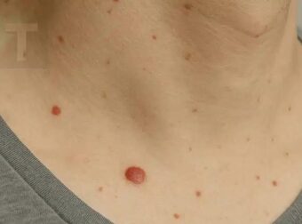 Γιατί εμφανίζονται κόκκινες κρεατοελιές στο δέρμα; Δείτε τι λέει η επιστήμη