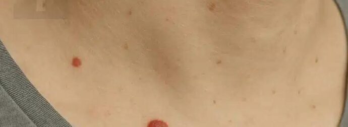 Γιατί εμφανίζονται κόκκινες κρεατοελιές στο δέρμα; Δείτε τι λέει η επιστήμη