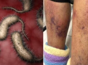 ΗΠΑ: Εμφανίστηκαν επικίνδυνα βακτήρια  – Αυξάνονται επικίνδυνα τα κρούσματα