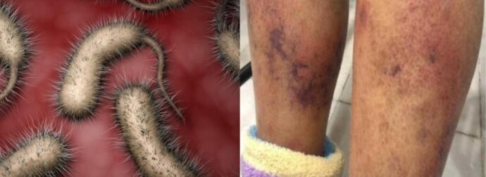 ΗΠΑ: Εμφανίστηκαν επικίνδυνα βακτήρια  – Αυξάνονται επικίνδυνα τα κρούσματα