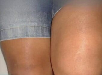 Γιατί το ένα γόνατο είναι πρησμένο αλλά όχι το άλλο;