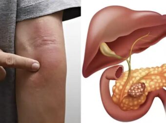 Το περίεργο σημάδι στο δέρμα που «δείχνει» καρκίνο στο πάγκρεας – Γρήγορα για εξετάσεις