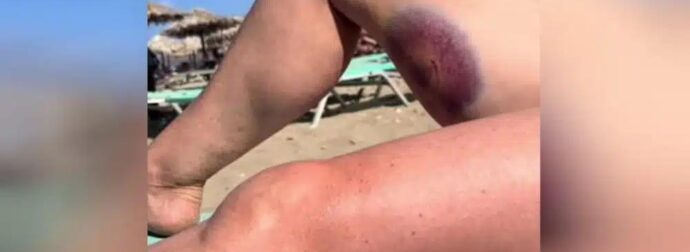 Κρήτη: Χελώνα έκανε διπλή επίθεση σε τουρίστρια δαγκώνοντάς την στο πόδι – Δείτε βίντεο