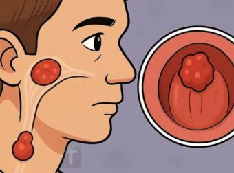 7 σημάδια καρκίvou ρινοφάρυγγα: Ο Νο1 πιο δύσκολος να θεραπευτεί αν δεν ανιχνευθεί έγκαιρα