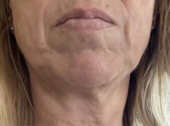 Ενδοκρινολόγος αποκαλύπτει τα δύο φαγητά που κάνουν το δέρμα να γερνά πιο γρήγορα