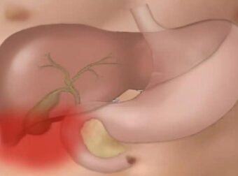 Το «φάpμακο του φτωχού»: Η πάμφθηνη τροφή για ένα Υγιές έντερο