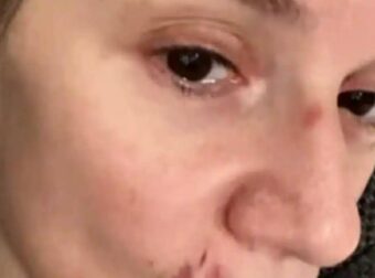 Με μαυρισμένο μάτι και με αίματα στο πρόσωπο η Πέγκυ Τρικαλιώτη: Παραπάτησε και χτύπησε στο πρόσωπο