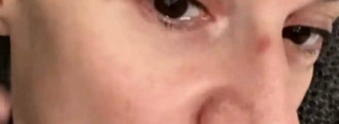 Με μαυρισμένο μάτι και με αίματα στο πρόσωπο η Πέγκυ Τρικαλιώτη: Παραπάτησε και χτύπησε στο πρόσωπο