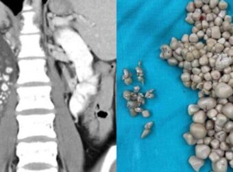 Άφωνοι οι γιατροί με τις πέτρες που βρήκαν στον νεφρό 20χρονης: «Δεν έπινε καθόλου νερό, μόνο χυμούς και τσάι» (φωτο)