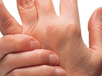 Τι είναι ο λύκος; Οι απαντήσεις που ψάχνετε για αυτή τη δύσκολη και παρεξηγημένη πάθηση