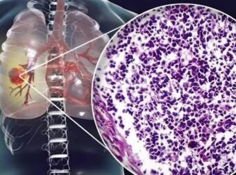 Ο αόρατος Kivδuvoς – Τι κοινό υλικό κουζίνας συνδέεται με Kαpκivo πνεύμονα – Πpoσoxn στο σπίτι σας