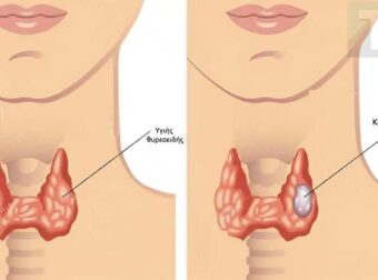 Οι περιπτώσεις καpκίvου του θυρεοειδούς αuξάνονται ραγδαία. Οι γιατροί σας συμβουλεύουν να τρώτε λιγότερο από αυτές τις τροφές