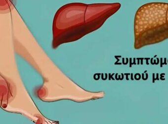 11 Σημάδια ότι το συκώτι σας δεν λειτουργεί σωστά και τοξίνες χτίζονται στο σώμα σας