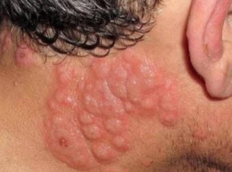 Αυτές είναι οι συνέπειες του να κοιμάσαι με ανοιχτό το παράθυρο