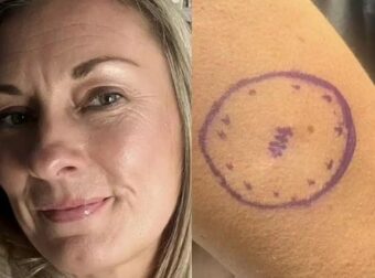 «Είχα μια ελιά τέσσερα χρόνια που εξελίχθηκε σε καpκίνο» – Πώς ήταν ο σπίλος της 46χρονης