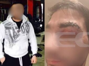 Αίγιο: Νεκρός ο μποξέρ που ξυλοκόπησε τον γιατρό μέσα στο νοσοκομείο