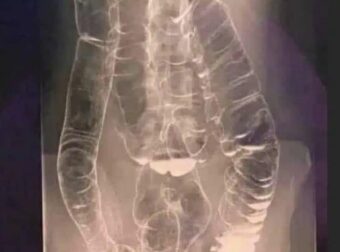 Χρόνια δυσκοιλιότητα – Μια σιωπηλή απειλή για την υγεία του πεπτικού συστήματος