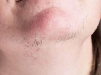 Τι μπορεί να σας λένε οι τρίχες του πηγουνιού για την υγεία σας