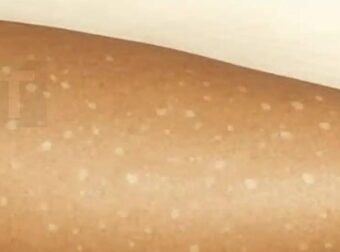 Λευκές κηλίδες στο δέρμα: Ποιες ελλείψεις βιταμινών μπορεί να είναι η αιτία