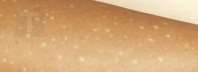 Λευκές κηλίδες στο δέρμα: Ποιες ελλείψεις βιταμινών μπορεί να είναι η αιτία