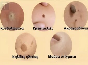 Αντιμετωπίστε φυσικά κηλίδες, κρεατοελιές, μυρμηγκιές και μαύρα στίγματα