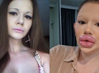 24χρονη εθισμένη στις πλαστικές παραφούσκωσε τα χείλη της, έγινε σαν πάπια και πιστεύει πως είναι και κουκλάρα