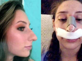 Γεννήθηκε με μεγάλη μύτη, την φώναζαν γυναίκα – ράμφος αλλά έκανε εγχείρηση και έγινε πιο όμορφη από μοντέλο