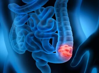 Σημάδια καρκίνου του παχέος εντέρου: Τα συμπτώματα που δεν πρέπει να αγνοήσετε