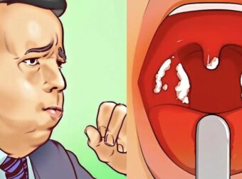 Έχετε συνεχώς βλέννα στον λαιμό; Αυτό σημαίνει Τι την προκαλεί και πότε πρέπει να σας ανησυχεί