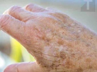 Τι πρέπει να ξέρετε αν εμφανιστούν κηλίδες στα χέρια σας