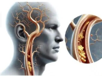 Βιταμίνη Κ2: Αποτρέπει τη συσσώρευση ασβεστίου στις αρτηρίες και την καρδιά