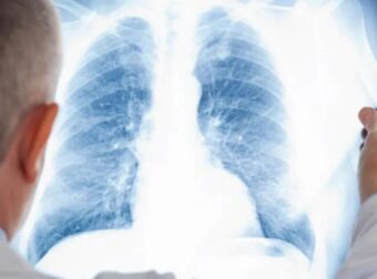 Γρίπη Α: Όταν ο ιός «μετακομίζει» στους πνεύμονες – Τα κρίσιμα σημάδια που δείχνουν πνευμονία