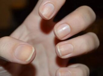Αν δείτε αυτό το σημάδι στα νύχια σας, πάρτε άμεσα τον γιατρό σας – «Δείχνει» ύπουλη και θανατηφόρα καρδιακή νόσο