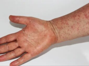 Γεμίζει εξανθήματα όλο σου το σώμα, «ψήνεσαι» στον πυρετό: Νέα επιδημία ιλαράς στις ΗΠΑ  – Αυξάνονται δραματικά τα κρούσματα