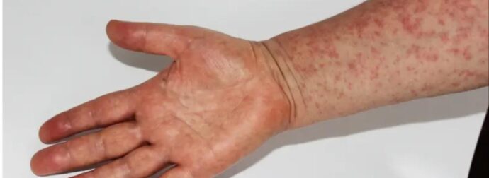 Γεμίζει εξανθήματα όλο σου το σώμα, «ψήνεσαι» στον πυρετό: Νέα επιδημία ιλαράς στις ΗΠΑ  – Αυξάνονται δραματικά τα κρούσματα