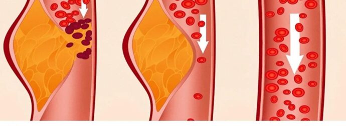 Τι είναι η δίαιτα ΝΤΑΣ και γιατί οι γιατροί την θεωρούν μια από τις καλύτερες για την υγεία