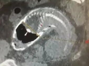 30χρονος είχε αφόρητους πόνους στο στομάχι – Αυτό που βρήκαν στο έντερό του σόκαρε τους γιατρούς