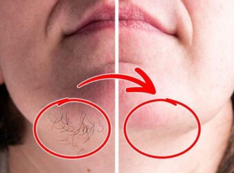 Τριχοφυΐα στο πρόσωπο: Αποτελεσματική, σπιτική συνταγή για να εξαφανίσετε τις ανεπιθύμητες τρίχες με φυσικό τρόπο