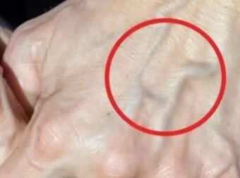 Έχετε ορατές φλέβες; Πότε πρέπει να ανησυχήσετε αν συμβαίνει αυτο