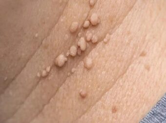 Αυτά τα μικρά δερματικά θηλώματα εμφανίζονται συνεχώς γύρω από τον λαιμό μου και δεν θα δω τον γιατρό μου για εβδομάδες. Τι μπορώ να κάνω άμεσα;