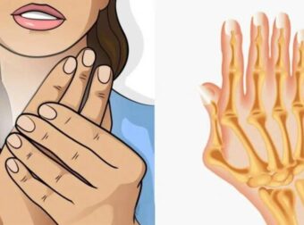 Ρευματοειδής αρθρίτιδα: Τα συνήθη συμπτώματα- Τι να τρώτε και τι να αποφεύγετε